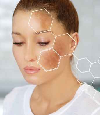 Melasma+treatment+in+Hyderabad