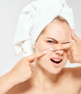 Acne+treatment+in+Hyderabad