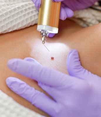 Moles+and+Warts+removal+in+Hyderabad