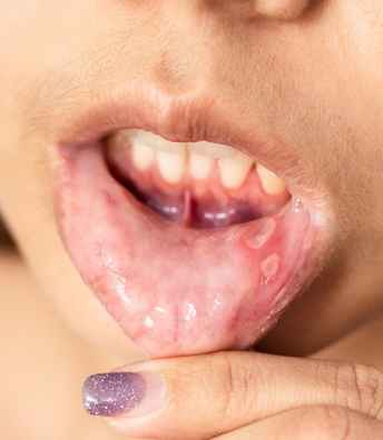 Mouth+Ulcers+treatment+in+ Hyderabad