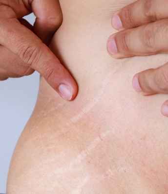 Stretch+Marks+treatment+in+Hyderabad