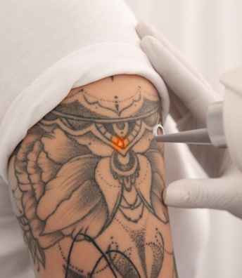 Tattoo+Removal+in+Hyderabad